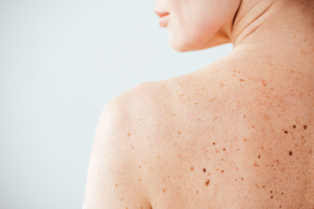 moca de costas com melanoma, uma doença de pele