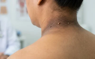 Sintomas de resistência à insulina na pele: o guia definitivo para identificação e tratamento